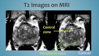 T2 Images on MRI
Central
zone
Peripheral zone Cancer
 