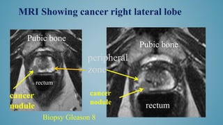 rectum
rectum
Pubic bone
peripheral
zone
cancer
nodule
Pubic bone
MRI Showing cancer right lateral lobe
Biopsy Gleason 8
cancer
nodule
 