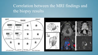 Correlation between the MRI findings and
the biopsy results
 