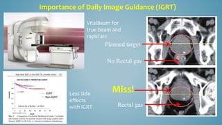 VitalBeam for
true beam and
rapid arc
Planned target
No Rectal gas
Rectal gas
Less side
effects
with IGRT
Miss!
Importance of Daily Image Guidance (IGRT)
 