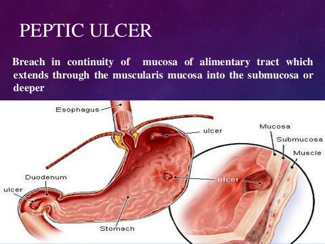 Ulcer Medicine Carafate