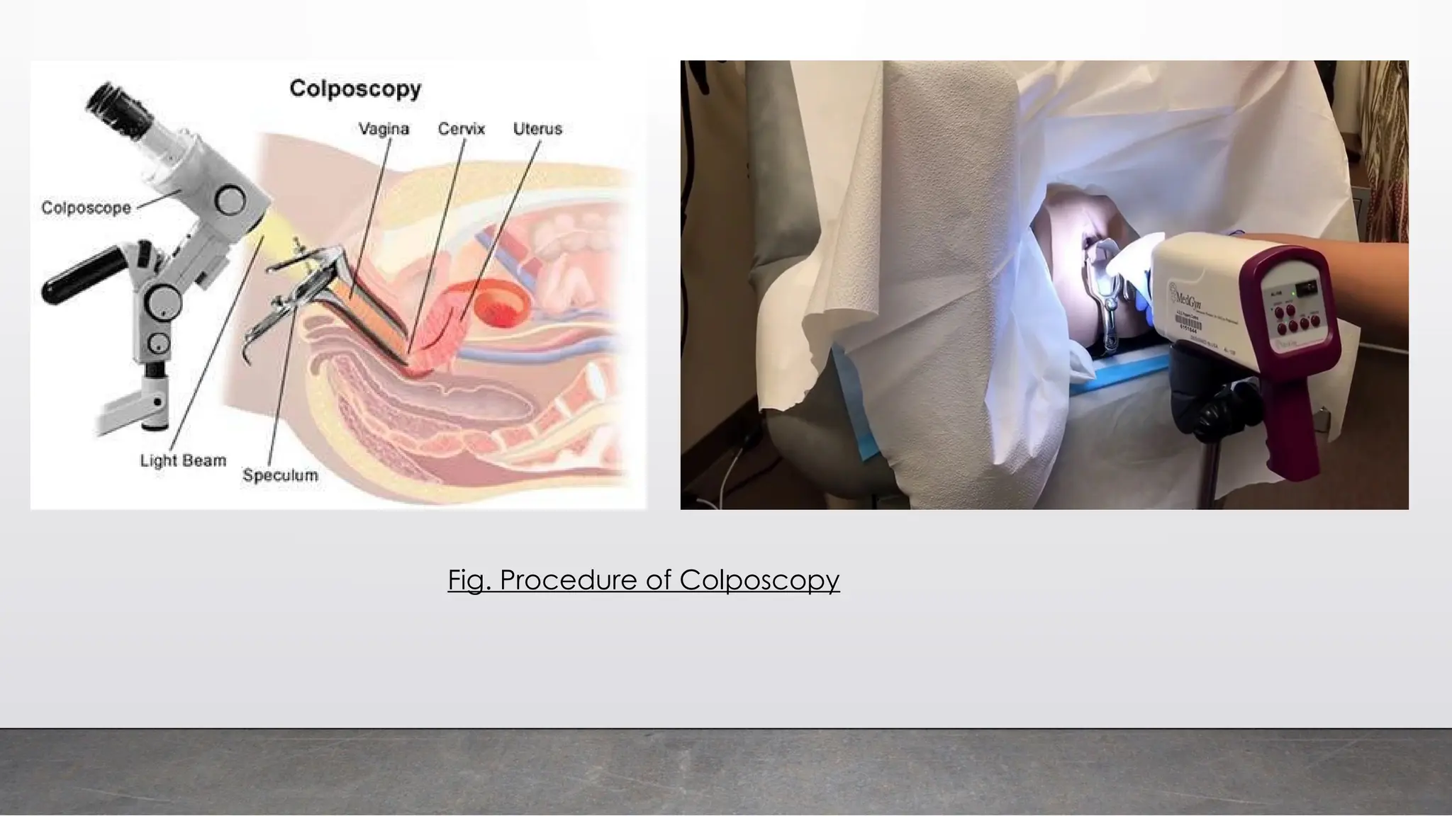 SCREENING & PREVENTION OF CANCER CERVIX.pptx