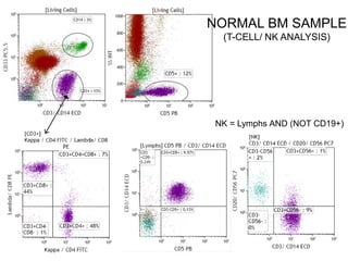 NK = Lymphs AND (NOT CD19+)
NORMAL BM SAMPLE
(T-CELL/ NK ANALYSIS)
 
