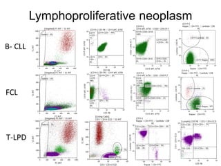 Lymphoproliferative neoplasm
B- CLL
FCL
T-LPD
 