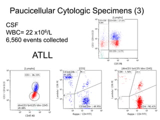 CSF
WBC= 22 x106/L
6,560 events collected
ATLL
Paucicellular Cytologic Specimens (3)
 