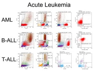 Acute Leukemia
AML
B-ALL
T-ALL
 