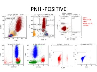 PNH -POSITIVE
CD14
NEGATIVE
PNH-
MONOCYTE
CLONE
 