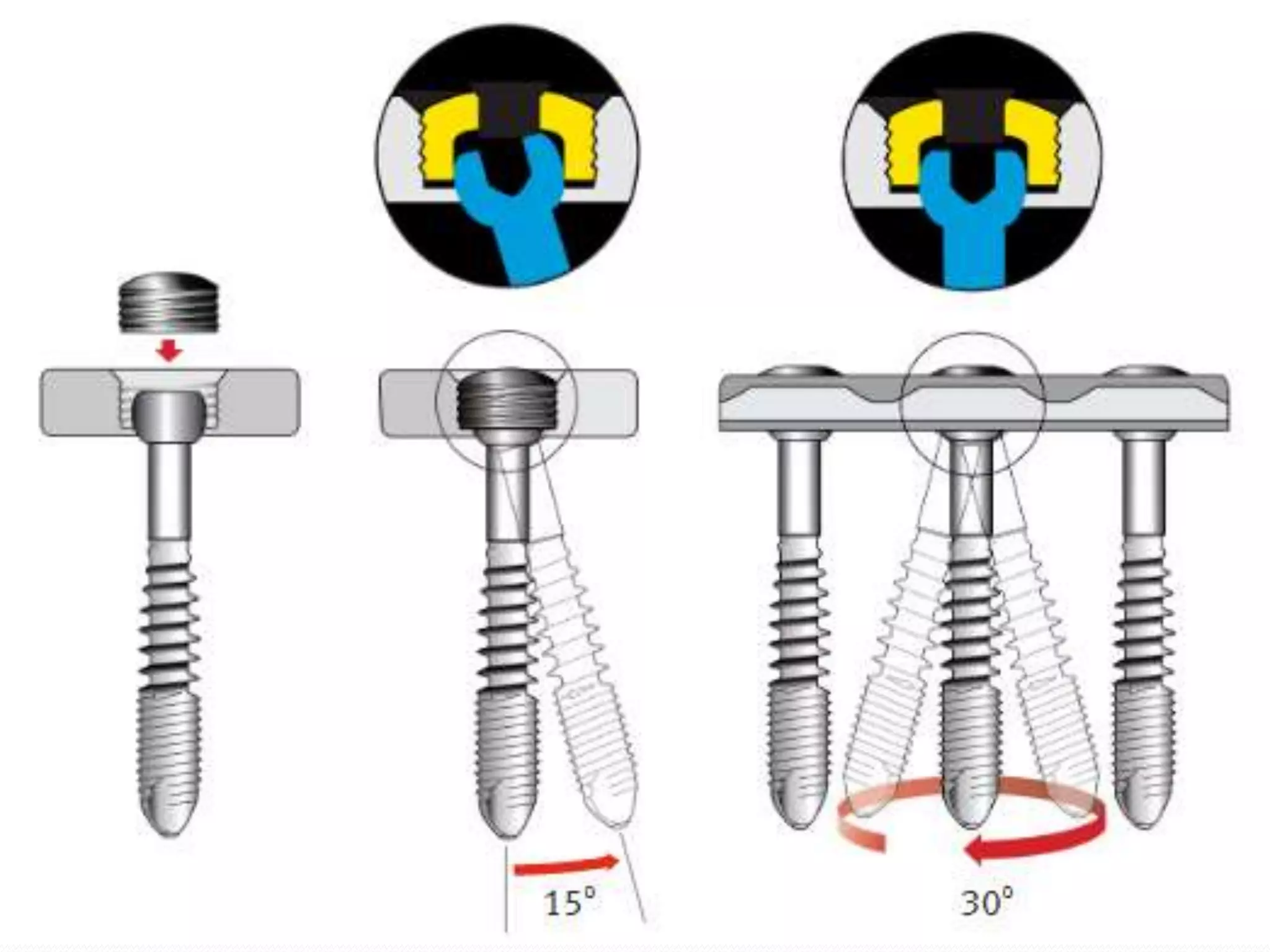SCREWS in orthopaedic surgery.pptx