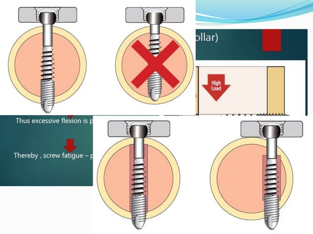 SCREWS in orthopaedic surgery.pptx | Needlework | Arts and Crafts