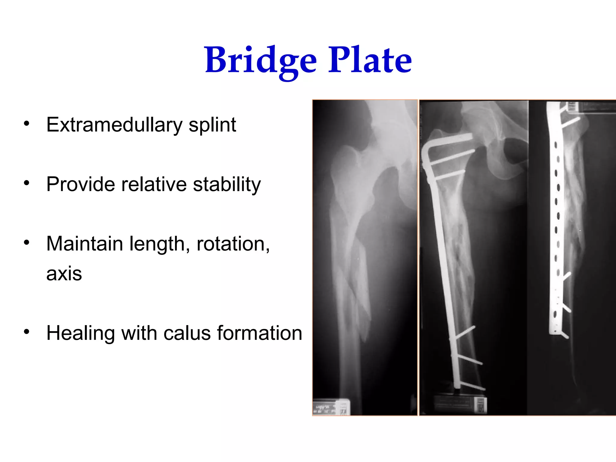 Screws and plates fixation | PPT