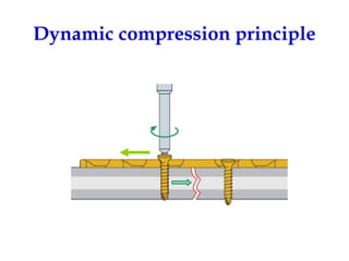 Screws and plates fixation | PPT