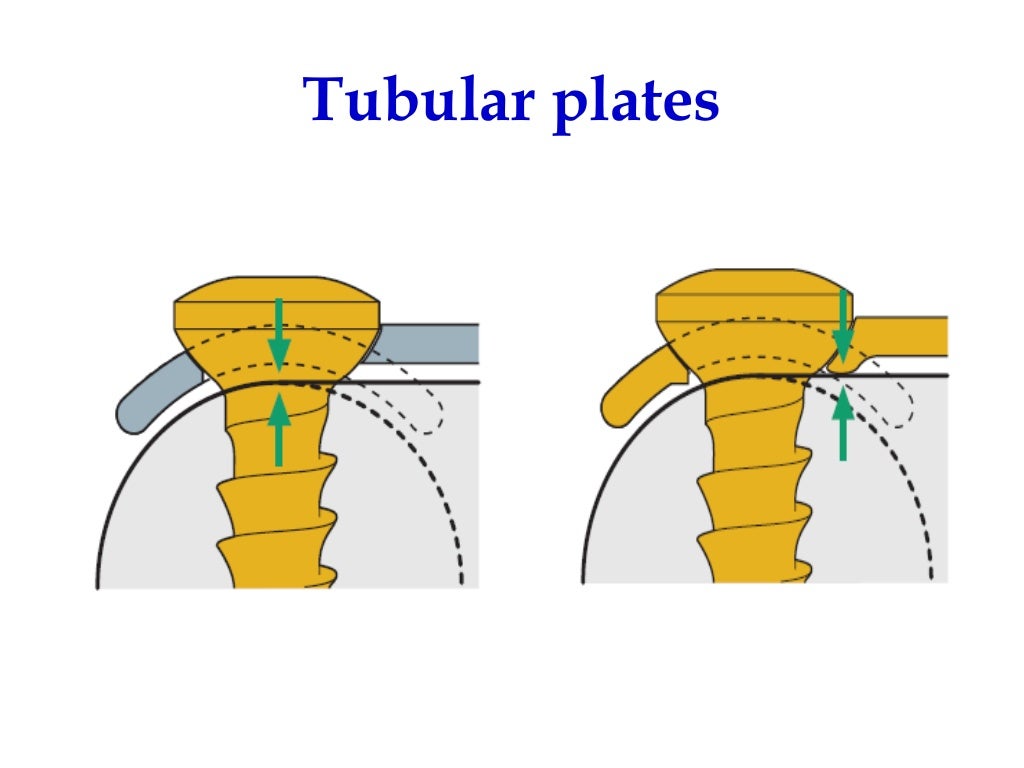 Screws and plates fixation