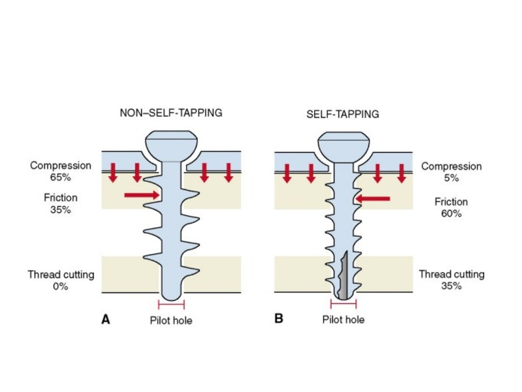 Screws and plates fixation