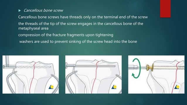 Basics of Screws in Orthopedics | PPTX