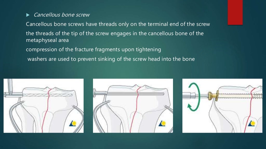 Basics of Screws in Orthopedics
