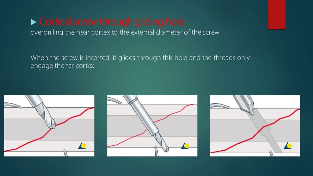 Basics of Screws in Orthopedics