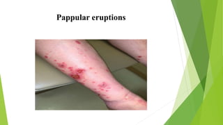 lithium toxicity | PPTX