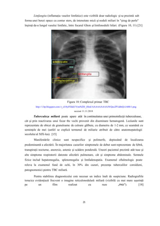 Limfangita (inflamația vaselor limfatice) este vizibilă doar radiologic și se prezintă sub
forma unei benzi opace cu contur sters, de intensitate mică și noduli miliari în "șirag de perle"
înșirați de-a lungul vasului limfatic, între focarul Ghon și limfonodulii hilari. (Figura 10, 11) [21]
Figura 10: Complexul primar TBC
http://1.bp.blogspot.com/-t_cU0y4YkkE/VmrNZH_iHmI/AAAAAAAAA38/Qes2P1idhtQ/s1600/1.png
accesat 11.11.2018
căt şi prin reactivarea unui focar tbc vechi provenit din diseminare hematogenă. Leziunile sunt
reprezentate de obicei de granuloame de culoare gălbuie, cu diametru de 1-2 mm, ce seamănă cu
seminţele de mei (astfel se explică termenul de miliarie atribuit de către anatomopatologii
secolului al XIX-lea). [15]
Manifestările clinice sunt nespecifice și polimorfe, depinzând de localizarea
predominantă a afectării. În majoritatea cazurilor simptomele de debut sunt reprezentate de febră,
transpiraţii nocturne, anorexie, astenie şi scădere ponderală. Uneori pacientul prezintă atât tuse şi
alte simptome respiratorii datorate afectării pulmonare, cât şi simptome abdominale. Semnele
fizice includ hepatomegalia, splenomegalia şi limfadenopatia. Examenul oftalmologic poate
releva la examenul fund de ochi, în 30% din cazuri, prezenţa tuberculilor coroidieni,
patognomonici pentru TBC miliară.
Pentru stabilirea diagnosticului este necesar un indice înalt de suspiciune. Radiografiile
toracice evidenţiază frecvent o imagine reticulonodulară miliară (vizibilă cu mai mare uşurinţă
pe un film realizat cu raze „moi"). [18]
25
 