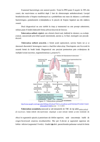 decesul.
Figura 11: Tuberculoza primară
2d4a3ad864774809accesat 11.11.2018
tuberculoză
de reactivare, boalaala rezultărezultă din reaaccttiivvareaarea endogendogenă a unei ininfececţţiiii latentelatente şi esesttee loclocalializzatatăă de
26
 