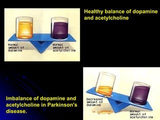 Healthy balance of dopamine
and acetylcholine
Imbalance of dopamine and
acetylcholine in Parkinson's
disease.
 