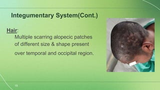 Scrofuloderma Presentation Scrofuloderma semi final-1.pptx