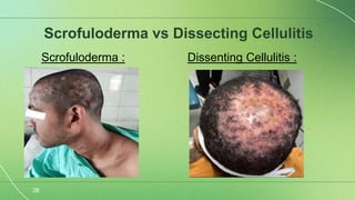 Scrolufoderma Scrofuloderma semi final-1.pptx