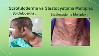 Scrolufoderma Scrofuloderma semi final-1.pptx