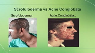 Scrolufoderma Scrofuloderma semi final-1.pptx