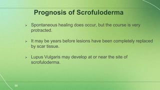 Scrolufoderma Scrofuloderma semi final-1.pptx