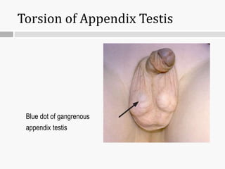 Torsion of Appendix Testis
Blue dot of gangrenous
appendix testis
 