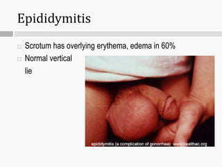 Epididymitis
 Scrotum has overlying erythema, edema in 60%
 Normal vertical
lie
 