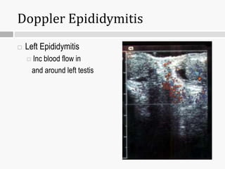 Doppler Epididymitis
 Left Epididymitis
 Inc blood flow in
and around left testis
 