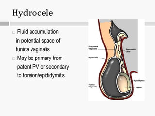 Hydrocele
 Fluid accumulation
in potential space of
tunica vaginalis
 May be primary from
patent PV or secondary
to torsion/epididymitis
 