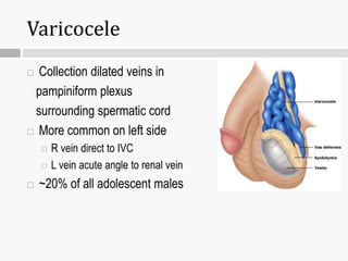 Varicocele
 Collection dilated veins in
pampiniform plexus
surrounding spermatic cord
 More common on left side
 R vein direct to IVC
 L vein acute angle to renal vein
 ~20% of all adolescent males
 
