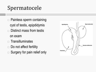 Spermatocele
 Painless sperm containing
cyst of testis, epipdidymis
 Distinct mass from testis
on exam
 Transilluminates
 Do not affect fertility
 Surgery for pain relief only
 