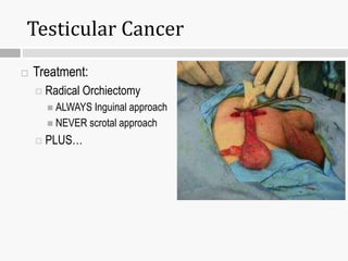 Testicular Cancer
 Treatment:
 Radical Orchiectomy
 ALWAYS Inguinal approach
 NEVER scrotal approach
 PLUS…
 