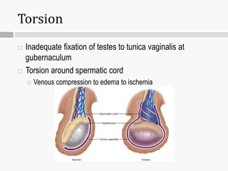 Torsion
 Inadequate fixation of testes to tunica vaginalis at
gubernaculum
 Torsion around spermatic cord
 Venous compression to edema to ischemia
 