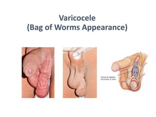 Varicocelectomy: Procedure, Purpose, Results, Cost, Price