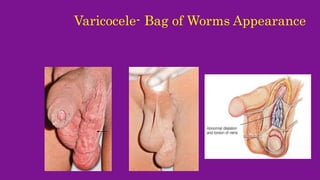 Varicocele - Médecine - Objectives: To understand the definition and causes  and treatment of - Studocu