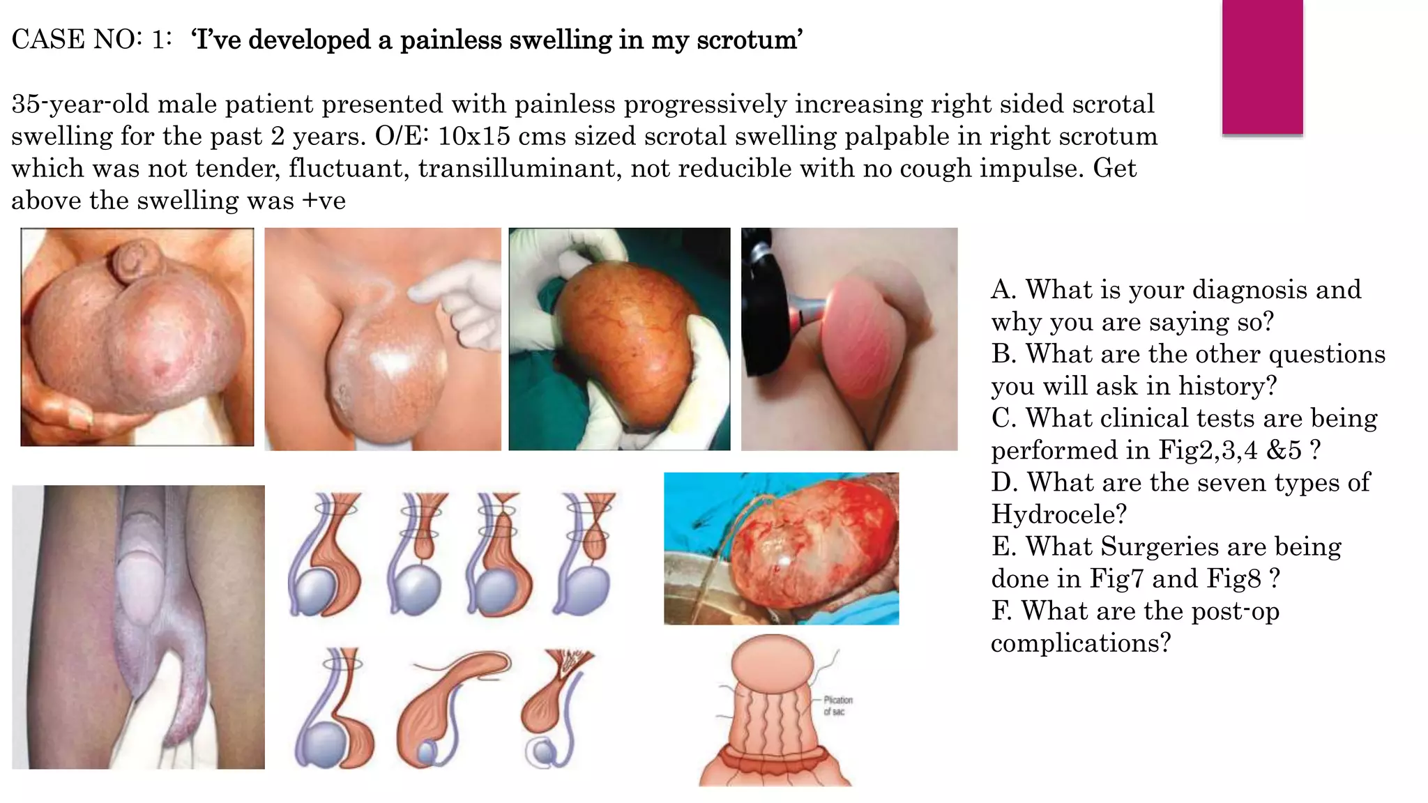 CASE NO: 1:
35-year-old male patient presented with painless progressively increasing right sided scrotal
swelling for the past 2 years. O/E: 10x15 cms sized scrotal swelling palpable in right scrotum
which was not tender, fluctuant, transilluminant, not reducible with no cough impulse. Get
above the swelling was +ve
A. What is your diagnosis and
why you are saying so?
B. What are the other questions
you will ask in history?
C. What clinical tests are being
performed in Fig2,3,4 &5 ?
D. What are the seven types of
Hydrocele?
E. What Surgeries are being
done in Fig7 and Fig8 ?
F. What are the post-op
complications?
‘I’ve developed a painless swelling in my scrotum’
 
