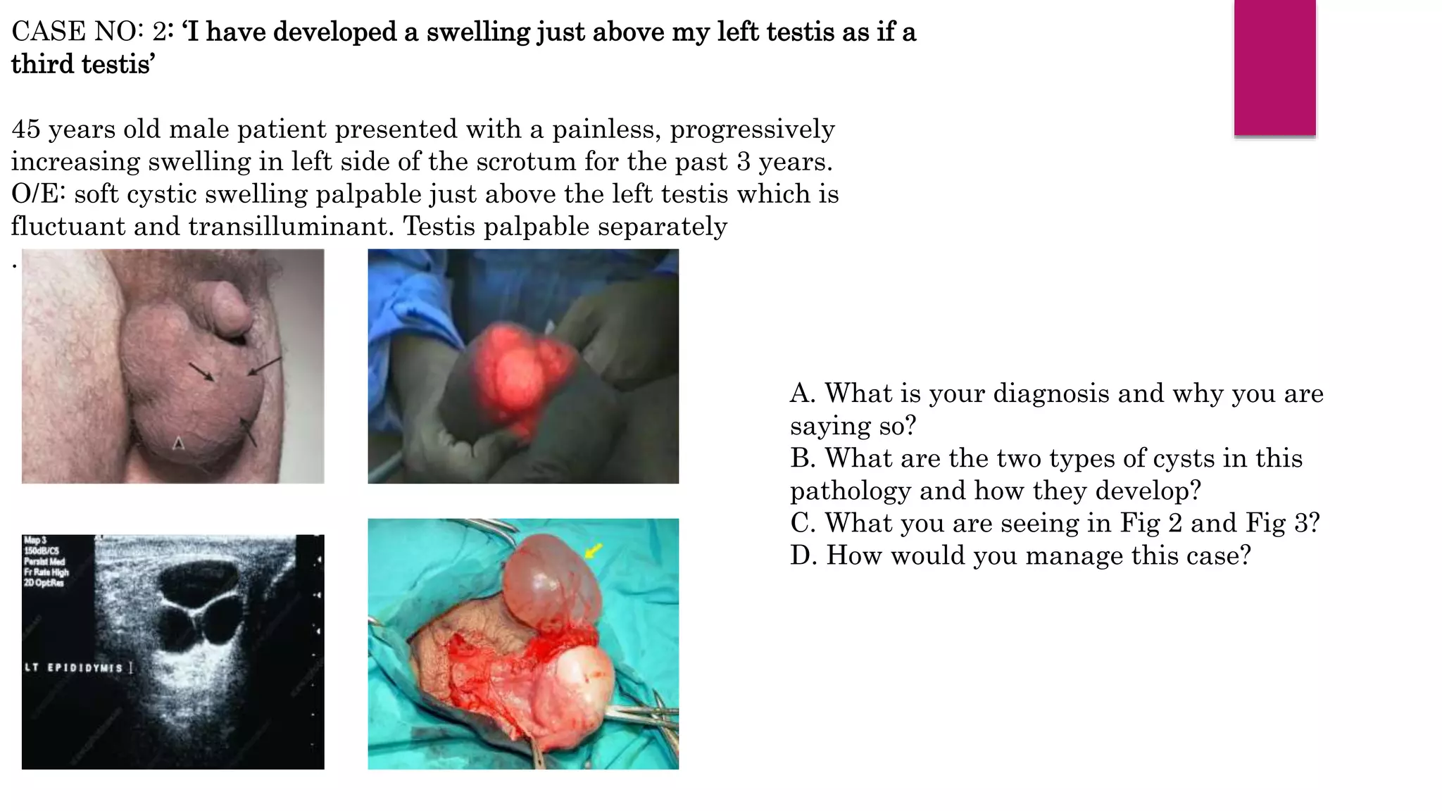 CASE NO: 2: ‘I have developed a swelling just above my left testis as if a
third testis’
45 years old male patient presented with a painless, progressively
increasing swelling in left side of the scrotum for the past 3 years.
O/E: soft cystic swelling palpable just above the left testis which is
fluctuant and transilluminant. Testis palpable separately
.
A. What is your diagnosis and why you are
saying so?
B. What are the two types of cysts in this
pathology and how they develop?
C. What you are seeing in Fig 2 and Fig 3?
D. How would you manage this case?
 