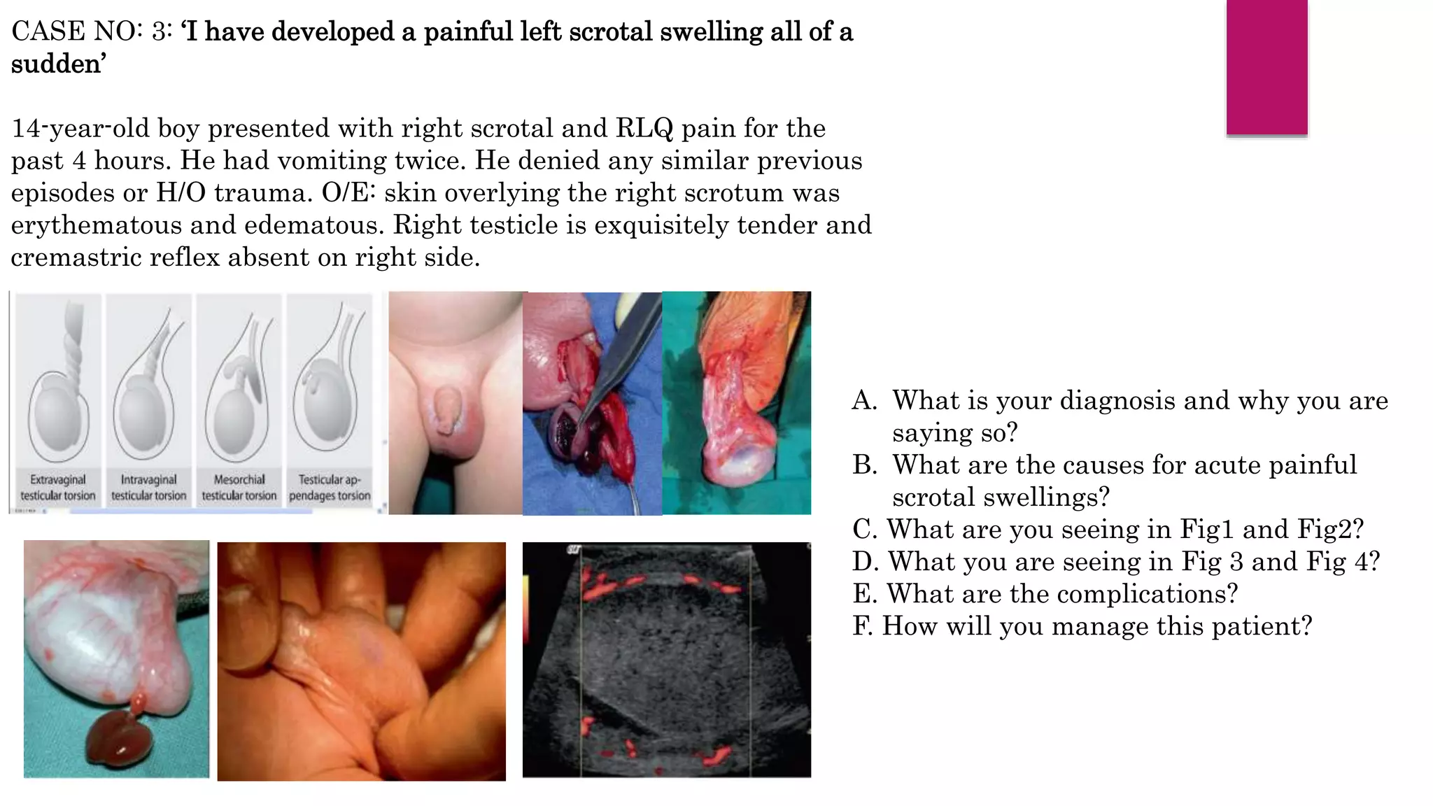 CASE NO: 3: ‘I have developed a painful left scrotal swelling all of a
sudden’
14-year-old boy presented with right scrotal and RLQ pain for the
past 4 hours. He had vomiting twice. He denied any similar previous
episodes or H/O trauma. O/E: skin overlying the right scrotum was
erythematous and edematous. Right testicle is exquisitely tender and
cremastric reflex absent on right side.
A. What is your diagnosis and why you are
saying so?
B. What are the causes for acute painful
scrotal swellings?
C. What are you seeing in Fig1 and Fig2?
D. What you are seeing in Fig 3 and Fig 4?
E. What are the complications?
F. How will you manage this patient?
 