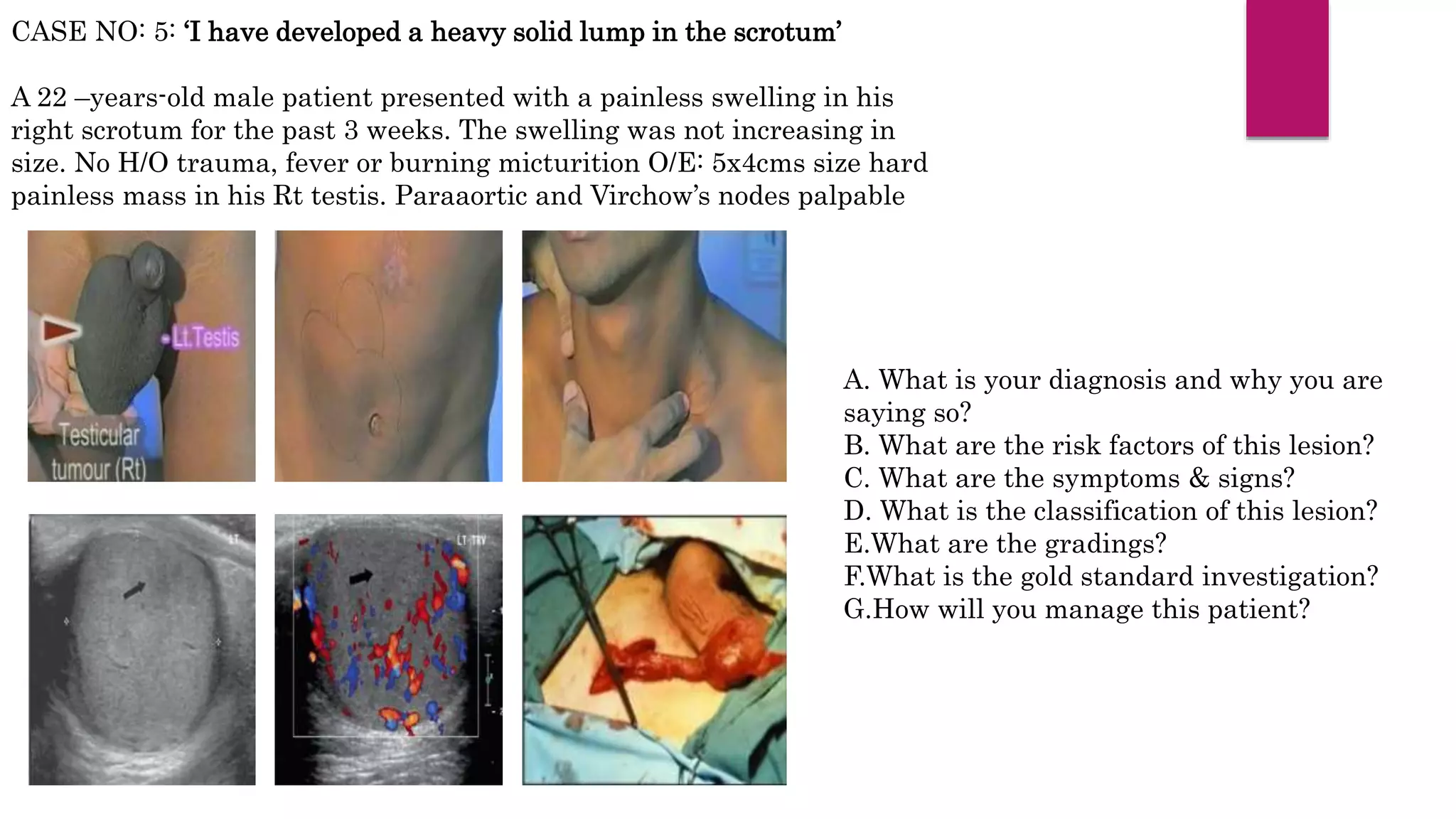 CASE NO: 5: ‘I have developed a heavy solid lump in the scrotum’
A 22 –years-old male patient presented with a painless swelling in his
right scrotum for the past 3 weeks. The swelling was not increasing in
size. No H/O trauma, fever or burning micturition O/E: 5x4cms size hard
painless mass in his Rt testis. Paraaortic and Virchow’s nodes palpable
A. What is your diagnosis and why you are
saying so?
B. What are the risk factors of this lesion?
C. What are the symptoms & signs?
D. What is the classification of this lesion?
E.What are the gradings?
F.What is the gold standard investigation?
G.How will you manage this patient?
 