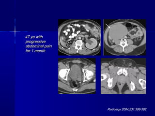 47 yo with47 yo with
progressiveprogressive
abdominal painabdominal pain
for 1 monthfor 1 month
Radiology 2004;231:388-392
 