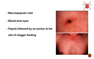  Maculopapular rash
 Blood-shot eyes
 Papule followed by an eschar at the
site of chigger feeding
 