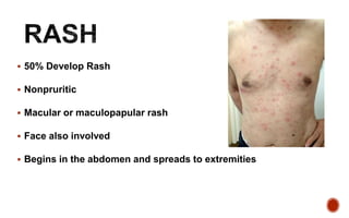  50% Develop Rash
 Nonpruritic
 Macular or maculopapular rash
 Face also involved
 Begins in the abdomen and spreads to extremities
 