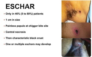  Only in 46% (5 to 80%) patients
 1 cm in size
 Painless papule at chigger bite site
 Central necrosis
 Then characteristic black crust
 One or multiple eschars may develop
 