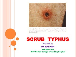 SCRUB TYPHUS
Prepared by
Dr. Anil Giri
MPH First Year
KIST Medical College & Teaching Hospital
 