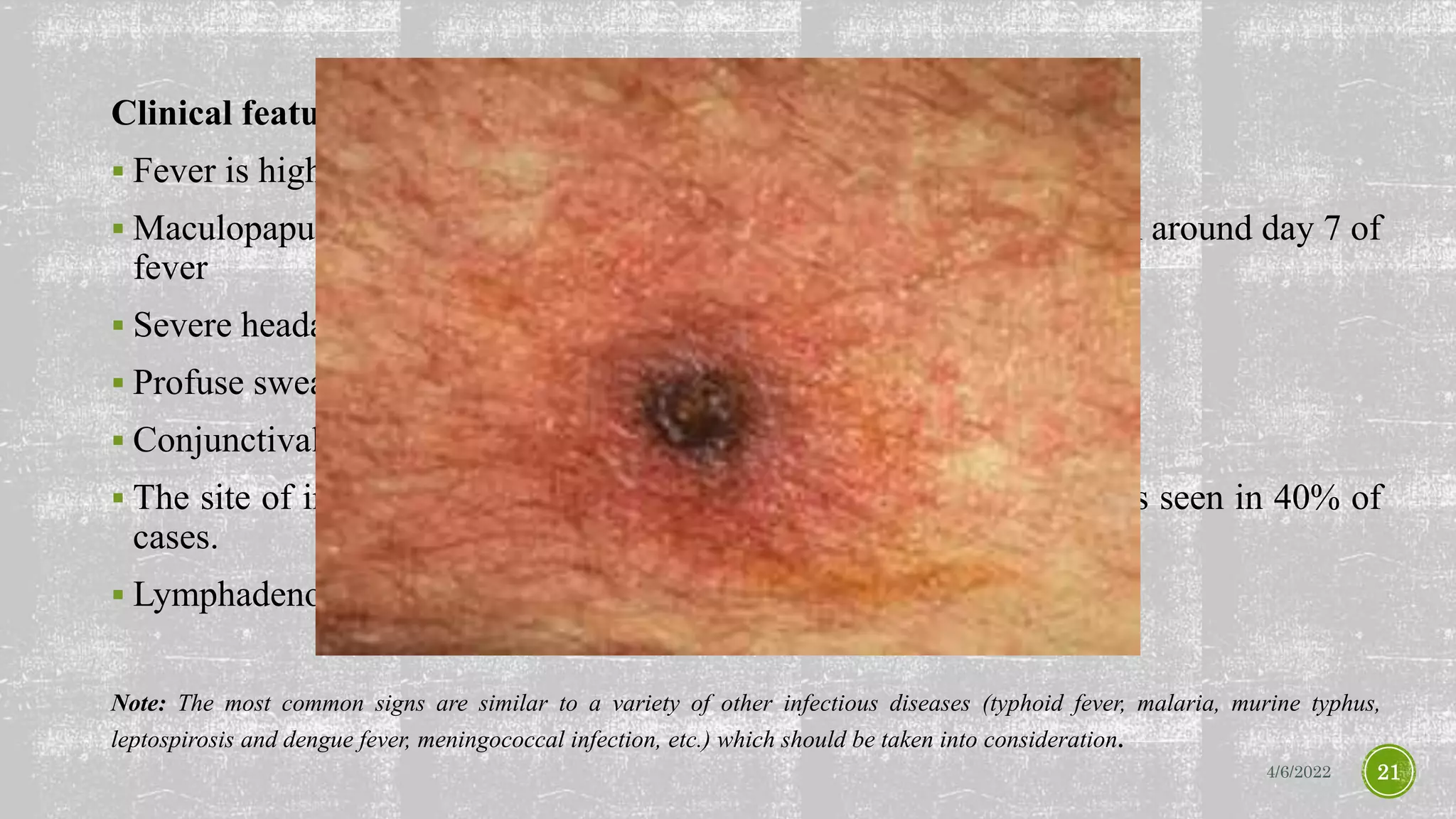 Clinical features:
 Fever is high grade (>1040F) and usually lasts 14 days.
 Maculopapular rash is seen over trunk, which is transient, and is seen around day 7 of
fever
 Severe headache
 Profuse sweating
 Conjunctival injection
 The site of insect bite is usually painless and a black eschar (scab) is seen in 40% of
cases.
 Lymphadenopathy
Note: The most common signs are similar to a variety of other infectious diseases (typhoid fever, malaria, murine typhus,
leptospirosis and dengue fever, meningococcal infection, etc.) which should be taken into consideration.
4/6/2022 21
 