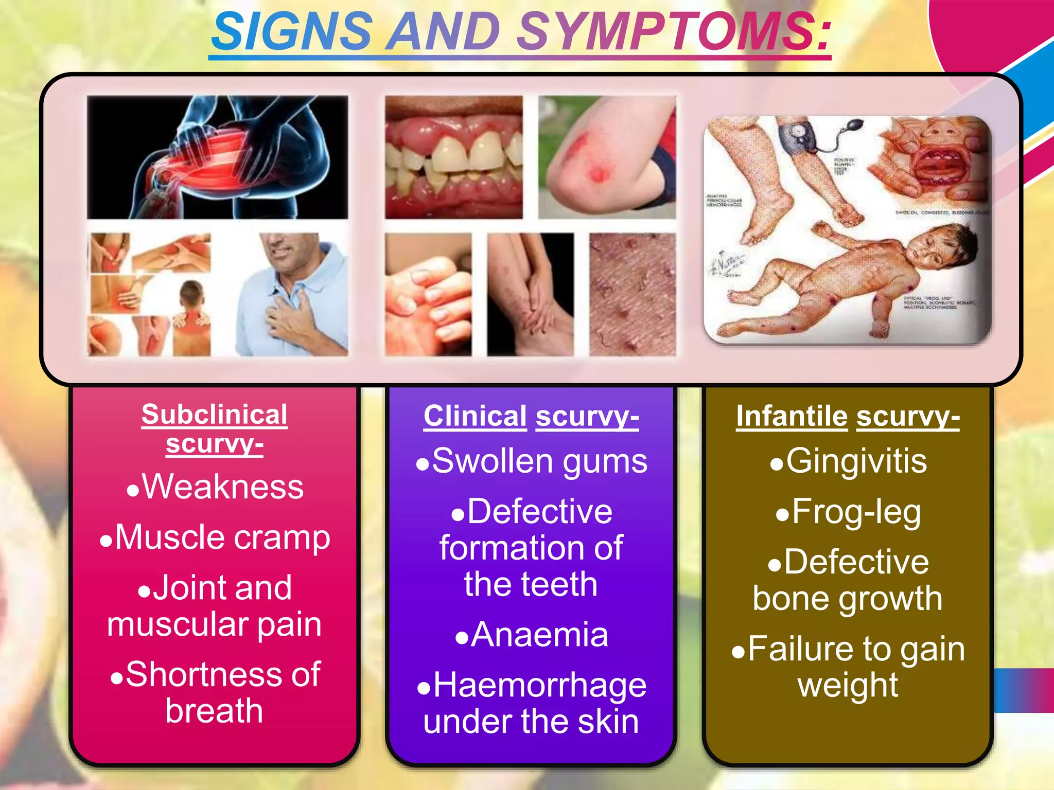 Vitamin C Deficiency Disease Scurvy PPT vitamin-c-deficiency-disease-scurvy-ppt